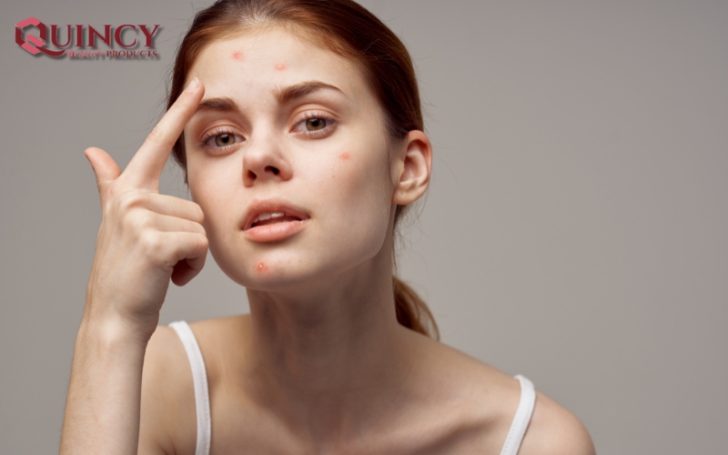 Bí quyết - Cách Trị Mụn Bọc Tại Nhà An Toàn và Hiệu Quả 100% 14 Bước 4: Chăm Sóc Da Hằng Ngày - Cách Trị Mụn Bọc Tại Nhà An Toàn