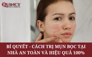 Bí quyết - Cách Trị Mụn Bọc Tại Nhà An Toàn và Hiệu Quả 100%