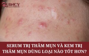 Serum trị thâm mụn và kem trị thâm mụn dùng loại nào tốt hơn?