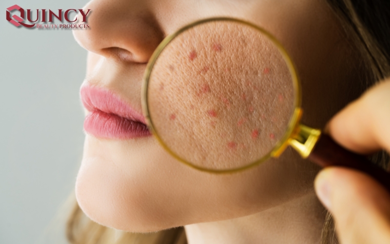 Mụn cám Papules là gì? Và các các cách điều trị hiệu quả? 19 Kết luận về Mụn cám Papules là gì?