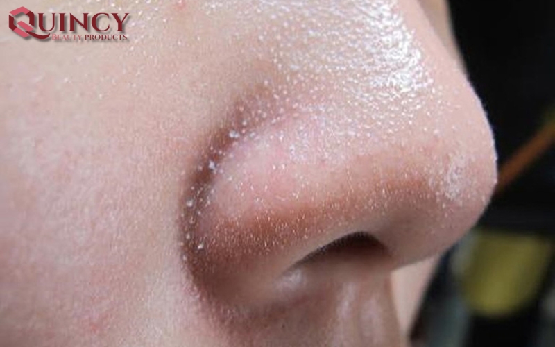 Cách phòng ngừa mụn cám - Mụn cám Papules là gì?