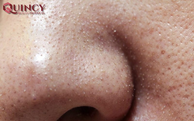 Các cách điều trị hiệu quả - Mụn cám Papules là gì?