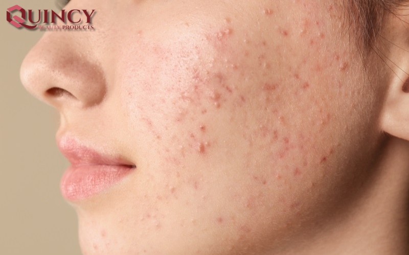 Các cách điều trị hiệu quả - Mụn cám Papules là gì?