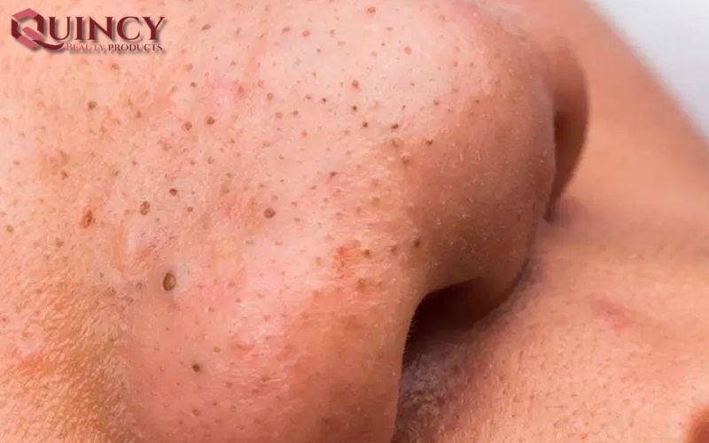 Mụn cám Papules là gì?