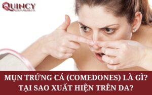 Mụn cám - Papules là gì? Và các các cách điều trị hiệu quả?