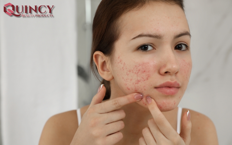 Mụn cám Papules là gì? Và các các cách điều trị hiệu quả? 11 Mụn cám Papules là gì và tầm quan trọng của việc hiểu về chúng