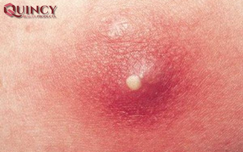 Mụn mủ Pustules là gì? Nguyên nhân, triệu chứng, cách điều trị 15 Cách điều trị Mụn mủ Pustules là gì?