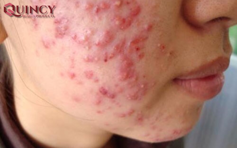 Triệu chứng của Mụn mủ Pustules là gì?