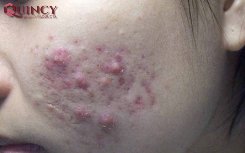 Mụn mủ Pustules là gì? Nguyên nhân, triệu chứng, cách điều trị 12 Nguyên nhân gây ra Mụn mủ Pustules là gì?