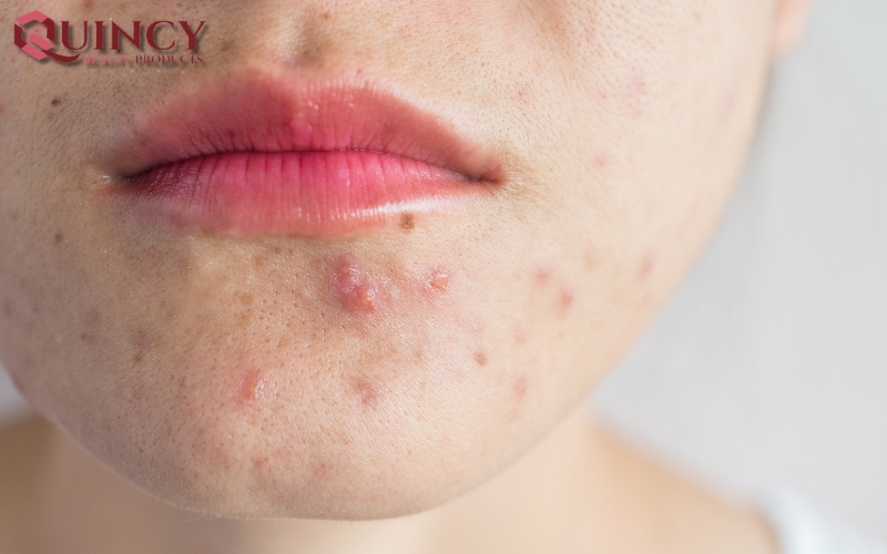 Mụn mủ Pustules là gì? Nguyên nhân, triệu chứng, cách điều trị 11 Mụn mủ Pustules là gì?