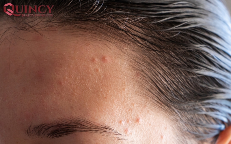 Mụn mủ Pustules là gì? Nguyên nhân, triệu chứng, cách điều trị 14 Cách điều trị Mụn mủ Pustules là gì?