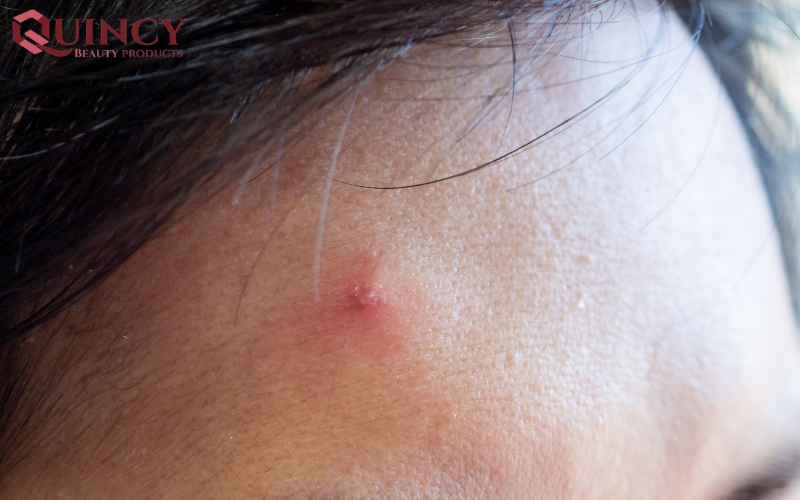 Mụn mủ Pustules là gì? Nguyên nhân, triệu chứng, cách điều trị 17 Kết luận về Mụn mủ Pustules là gì?