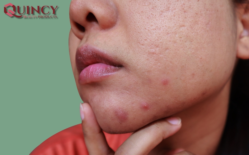 Cách điều trị Mụn mủ Pustules là gì?