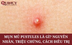 Mụn mủ Pustules là gì? Nguyên nhân, triệu chứng, cách điều trị