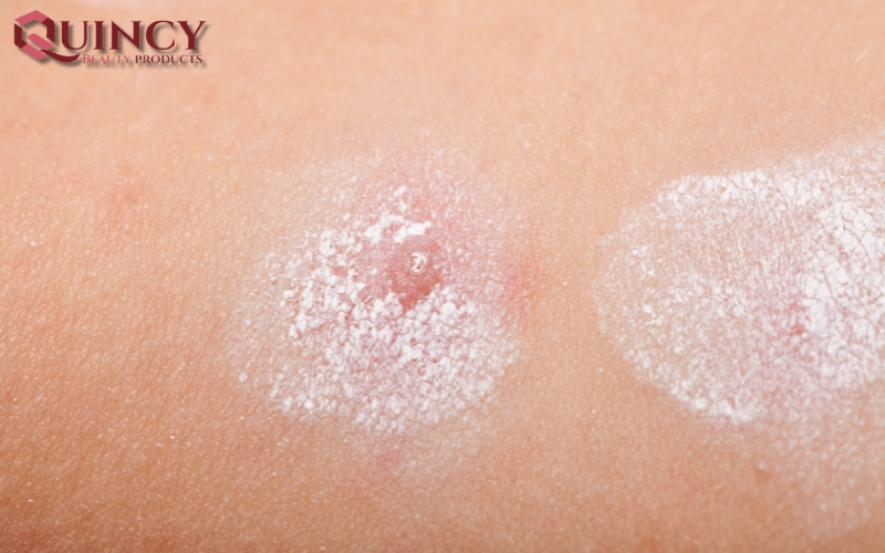 Mụn mủ Pustules là gì? Nguyên nhân, triệu chứng, cách điều trị 10 Tầm quan trọng của việc hiểu về Mụn mủ Pustules là gì?