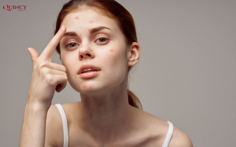 Nên sử dụng sản phẩm chấm mụn ở bước nào