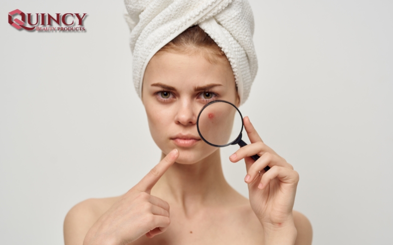 Tips và lời khuyên - Nhóm Điều trị/ngăn ngừa Các Vấn Đề Mụn