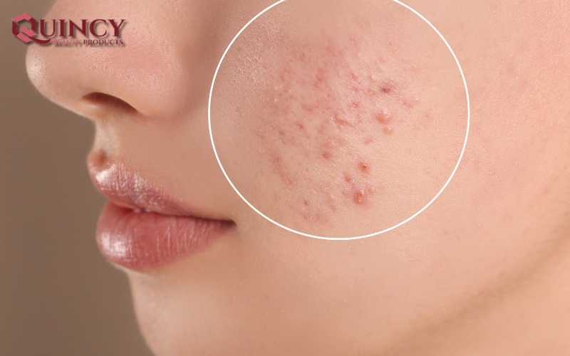 Tips và lời khuyên - Nhóm Điều trị/ngăn ngừa Các Vấn Đề Mụn