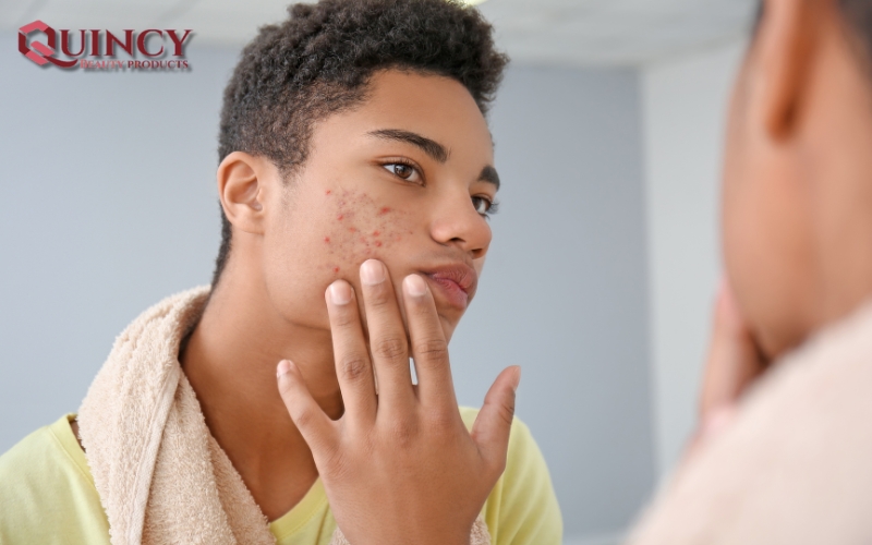 Nhóm Điều trị/ngăn ngừa Các Vấn Đề Mụn