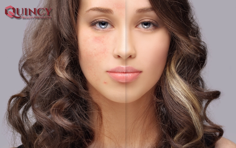 Nhóm Điều trị/ngăn ngừa Các Vấn Đề Mụn