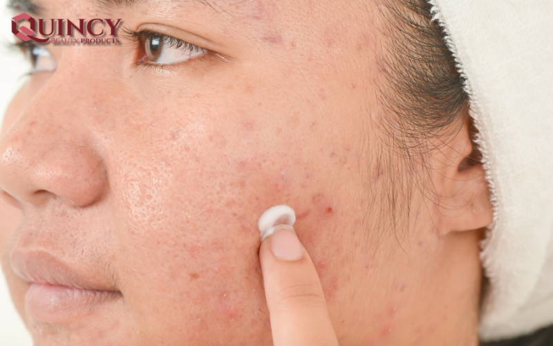 Hiểu về mụn - Nhóm Điều trị/ngăn ngừa Các Vấn Đề Mụn