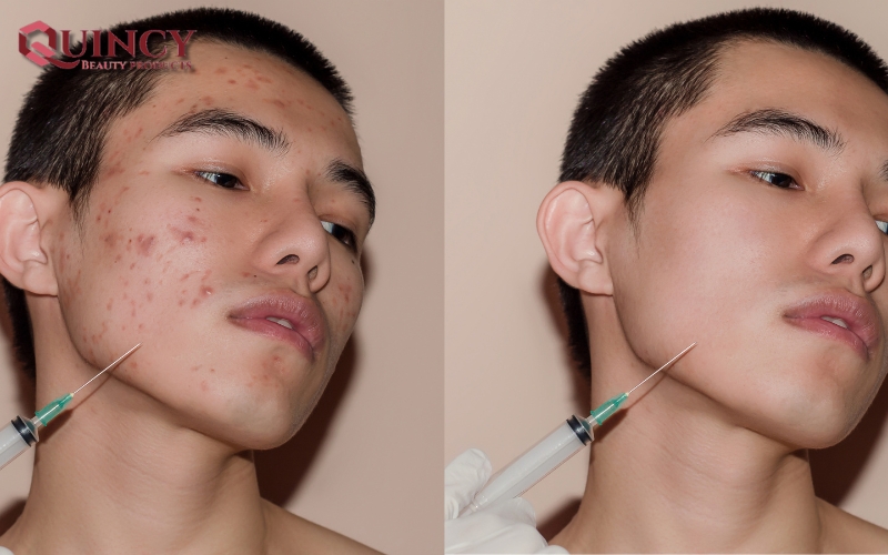 Serum trị thâm mụn - Serum trị thâm mụn và kem trị thâm mụn dùng loại nào tốt hơn?