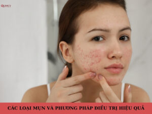 các loại mụn