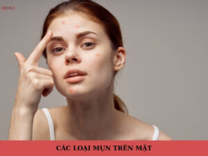 các loại mụn trên mặt