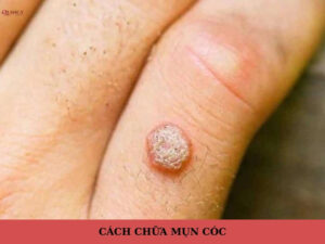 cách chữa mụn cóc