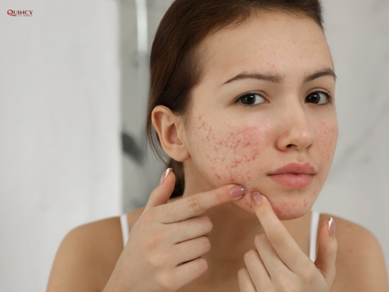 cách hết mụn