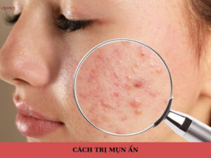 Các cách trị mụn ẩn 