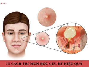 cách trị mụn bọc an toàn