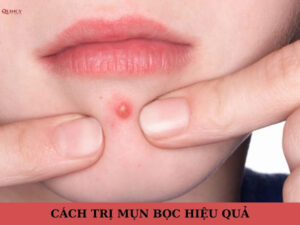 cách trị mụn bọc hiệu quả