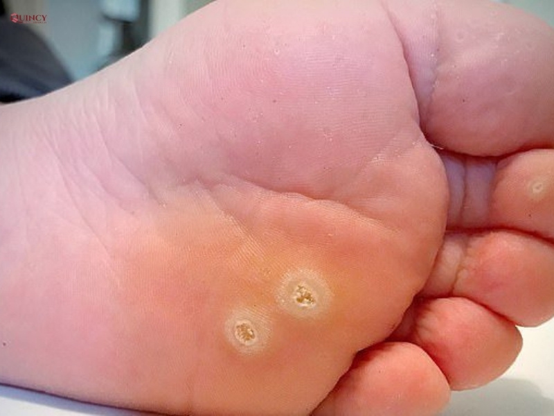 Bật mí cách trị mụn cóc tại nhà cực kỳ hiệu quả 14 Cách trị mụn cóc