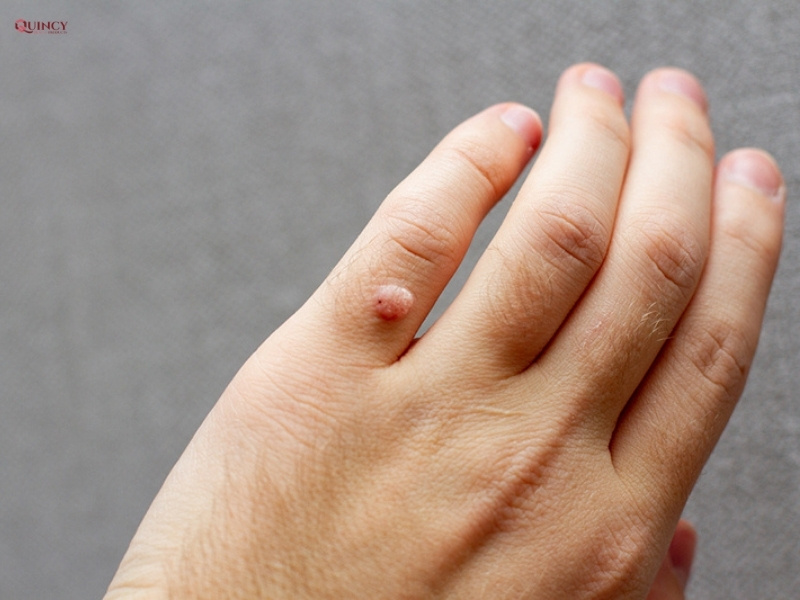 Cách trị mụn cóc