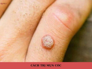 Cách trị mụn cóc