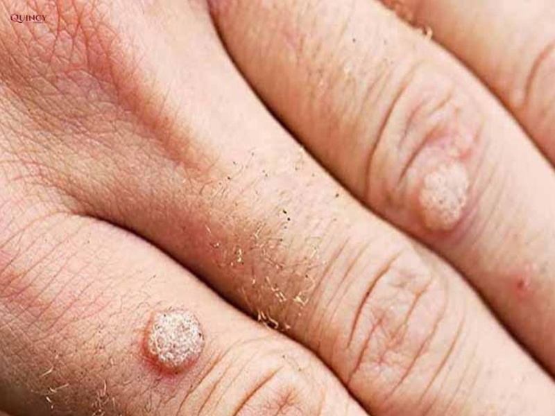 Bật mí cách trị mụn cóc tại nhà cực kỳ hiệu quả 16 Cách trị mụn cóc