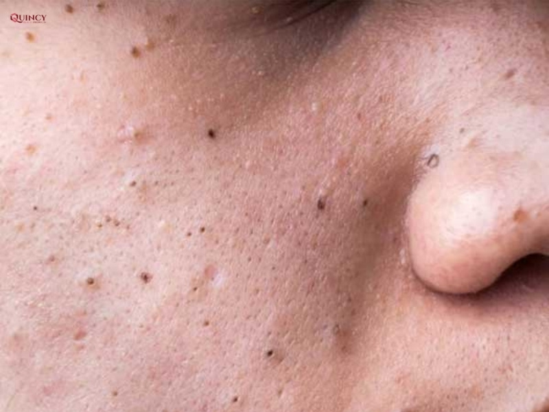 Các cách trị mụn đầu đen an toàn cho làn da 12 Cách trị mụn đầu đen