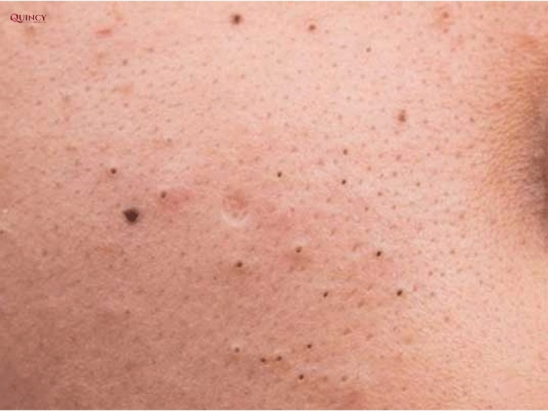 Cách trị mụn đầu đen