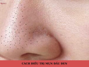 Cách trị mụn đầu đen