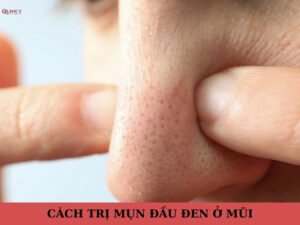 cách trị mụn đầu đen ở mũi