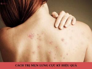 cách trị mụn lưng