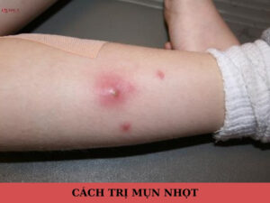 cách trị mụn nhọt