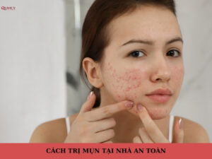 cách trị mụn tại nhà