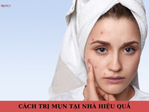 cách trị mụn tại nhà hiệu quả