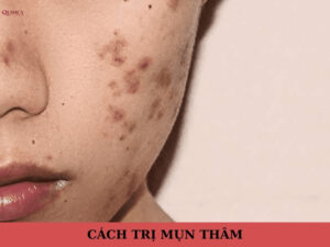 cách trị mụn thâm