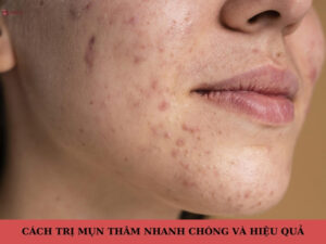 cách trị thâm mụn