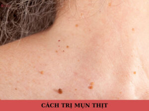 cách trị mụn thịt