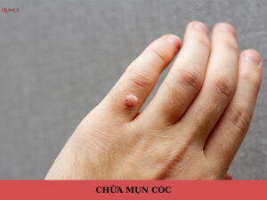 chữa mụn cóc