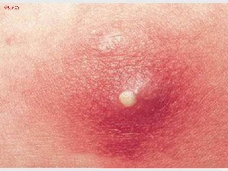 Cách hút mủ mụn nhọt nhanh nhất 9 hút mủ mụn nhọt